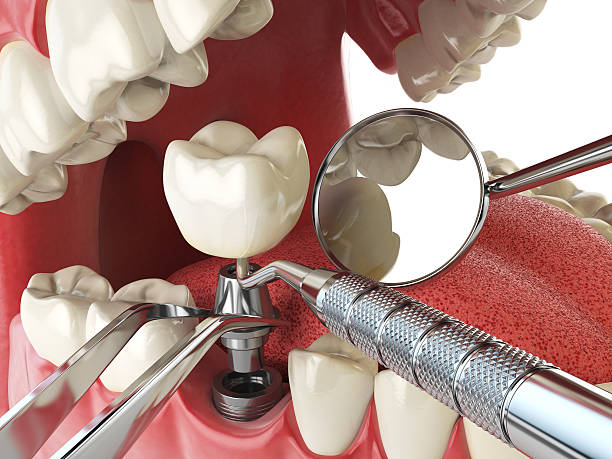 Best Knocked-Out Tooth (Avulsed Tooth) Treatment in Lake Holm, WA